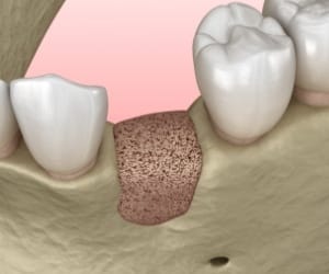 Animated smile after bone graft placement