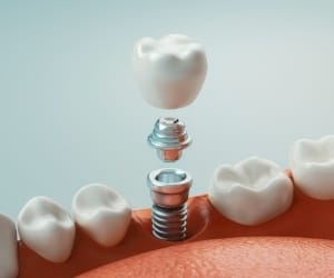 Animated immediate dental implant placement procedure