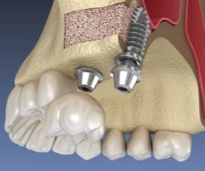 Animated dental implant placement after sinus lift