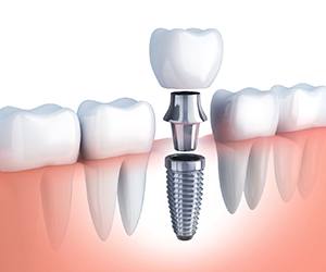 A digital image of a dental implant and all its parts