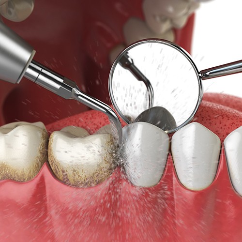 Illustration of a dental cleaning in Fort Myers, FL