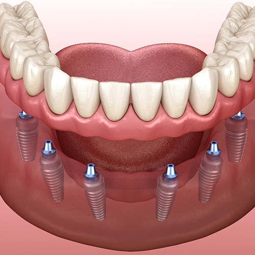 Digital illustration of implant dentures in Fort Myers