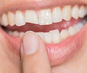 Smile with chipped front tooth