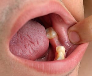 Smile with knocked out tooth