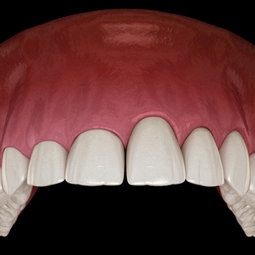 Digital illustration of gum recontouring in Fort Myers
