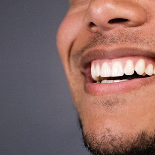 Man smiling after gum recontouring in Fort Myers