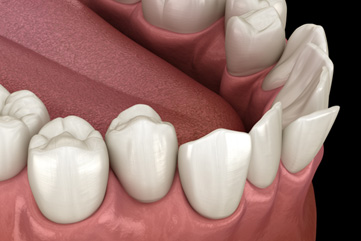 Illustration of crowded teeth