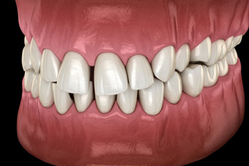 Illustration of gapped teeth