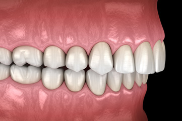 Illustration of an overbite