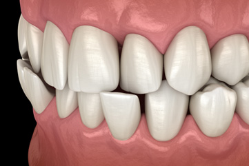 Illustration of a crossbite