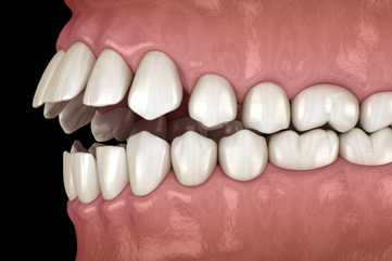 Illustration of an open bite