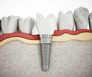 3D illustration of a dental implant in Ft. Meyers