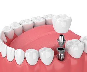 3D illustration of a dental implant, abutment, and crown