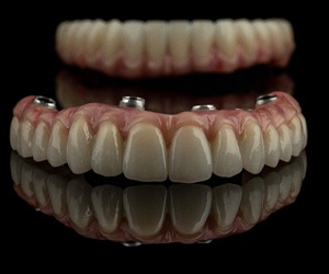 Denture designed for dental implants in Fort Myers