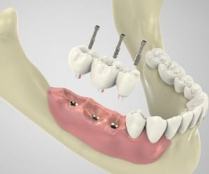 Guided dental implant surgery