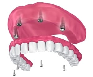 Animated immediate load denture