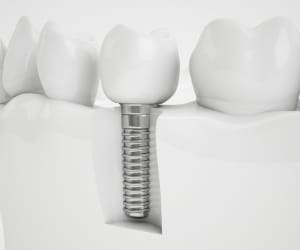 Animated mini dental implant supported dental crown