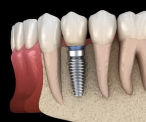 Animated dental implant supported dental crown