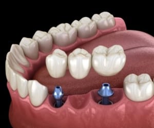 Animated dental implant supported dental bridge