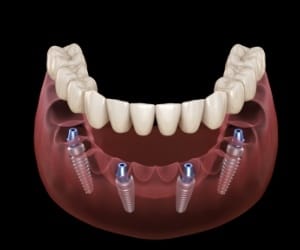 Animated dental implant supported denture