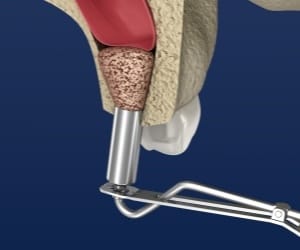 Animated ridge augmentation procedure