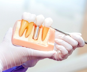 Using model to explain details of dental implants