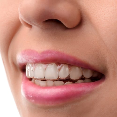 Closeup of smile Invisalign tray in place