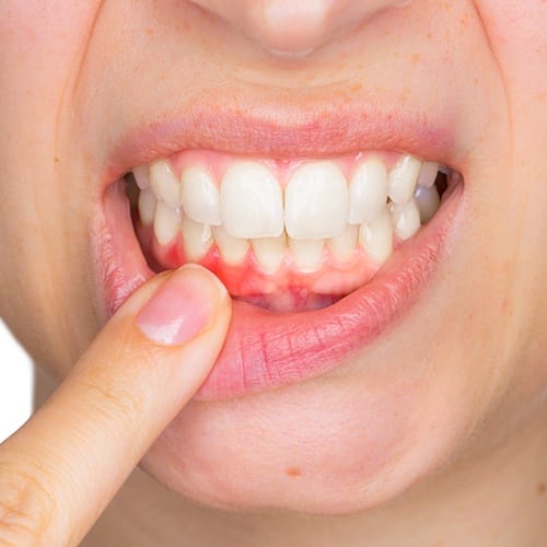 Smile with red inflamed gum tissue before periodontal therapy