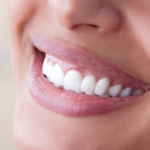 Closeup of smile after gum grafting treatment