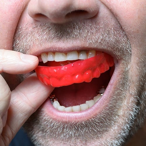 Man placing read athletic mouthguard