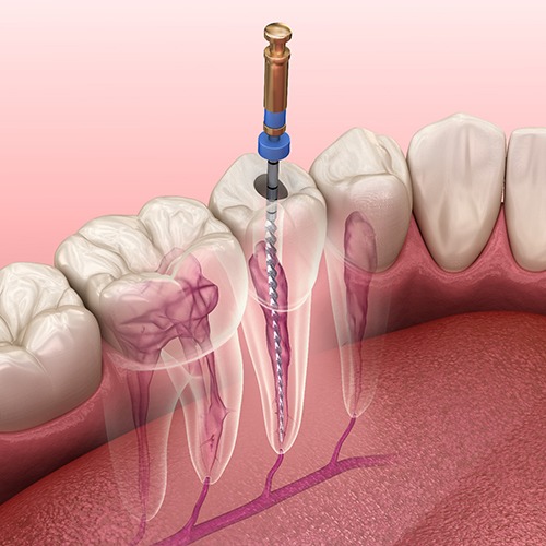 A 3D illustration of a root canal