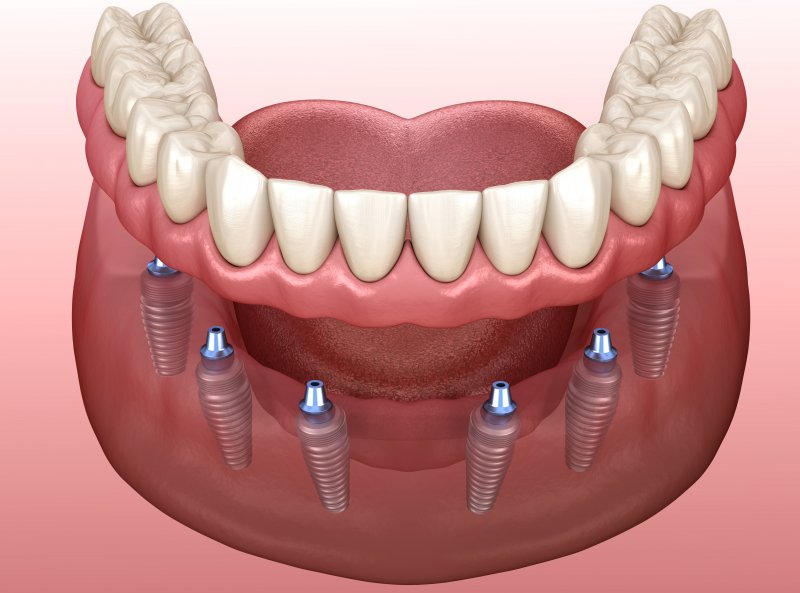 A diagram of an implant-retained denture.