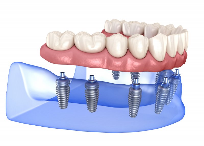 example of implant dentures in Fort Myers