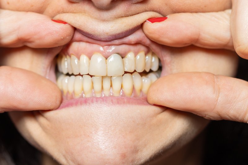 person showing gums in Fort Myers