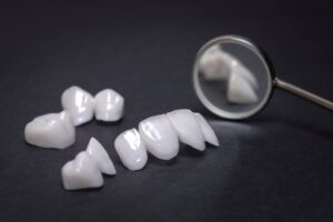 Close-up of veneers.
